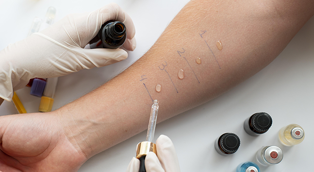 prick-test-alergia